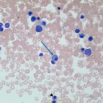 Figure 2. Late erythroid precursors (black arrowhead) and a plasma cell (blue arrow). Wright-Giemsa stain. 500x magnification.