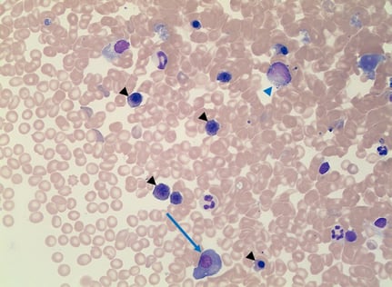 Erythroid (black arrowheads) and myeloid (blue arrowhead) precursors with a plasma cell (blue arrow. Wright-Giemsa stain. 500x magnification.