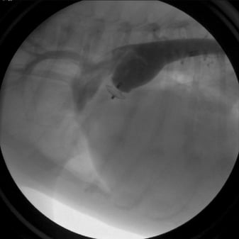 Figure 3: Contrast is injected into the aorta following device detachment from the delivery cable. The PDA occlusion device has completely stopped abnormal blood flow through the defect.