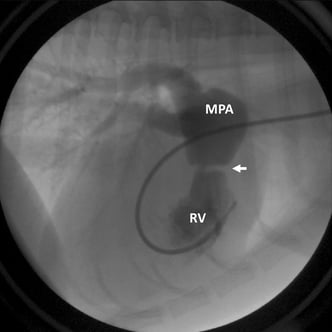 Figure 5: Contrast is injected into the right ventricle (RV), flows into the main pulmonary artery (MPA), and then out to the lungs. A discrete narrowing of the contrast column (arrow) indicates an obstruction at the level of the pulmonic valve.