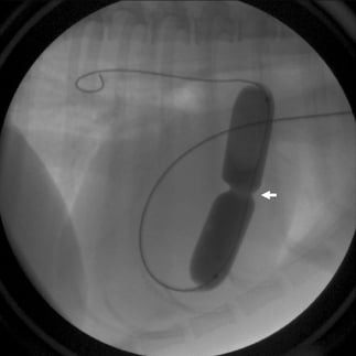 Figure 6: A balloon catheter has been advanced from a vein in the neck, into the right heart, and across the defective valve. The balloon is inflated with diluted contrast, creating an indentation at the level of valve narrowing (arrow) that is subsequently dilated upon full inflation.