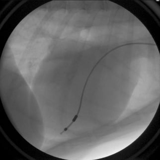 Figure 9: A pacemaker lead is in contact with the heart muscle inside the right ventricle.