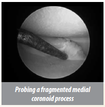 mis-2minimally invasive surgery (MIS) probing a Fragmented medial coronoid process