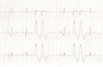 Figure 2. Lead I-III in a dog showing an underlying sinus rhythm with two, ventricular couplets. 