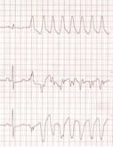 Figure 3. Lead I-III in a dog showing one sinus beat followed by ventricular tachycardia.